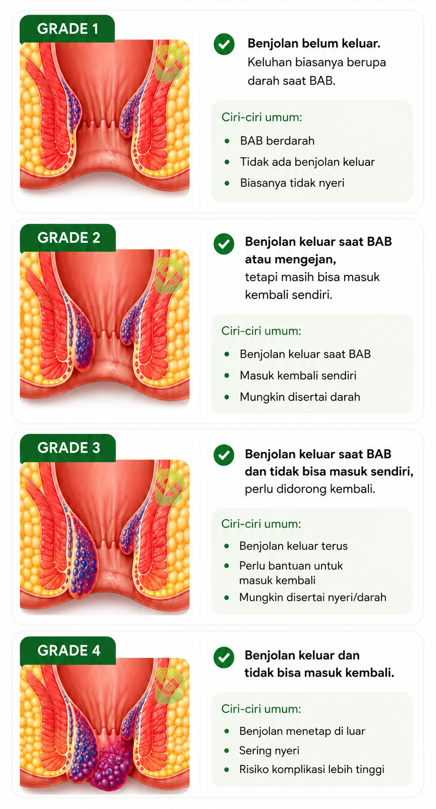 Tingkatan Wasir